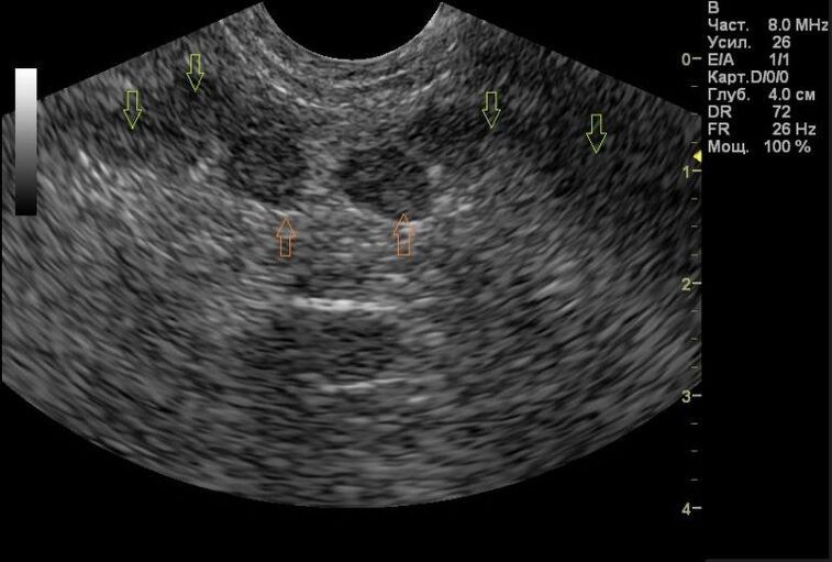 prostatitis op meng Ultraschall Resultater